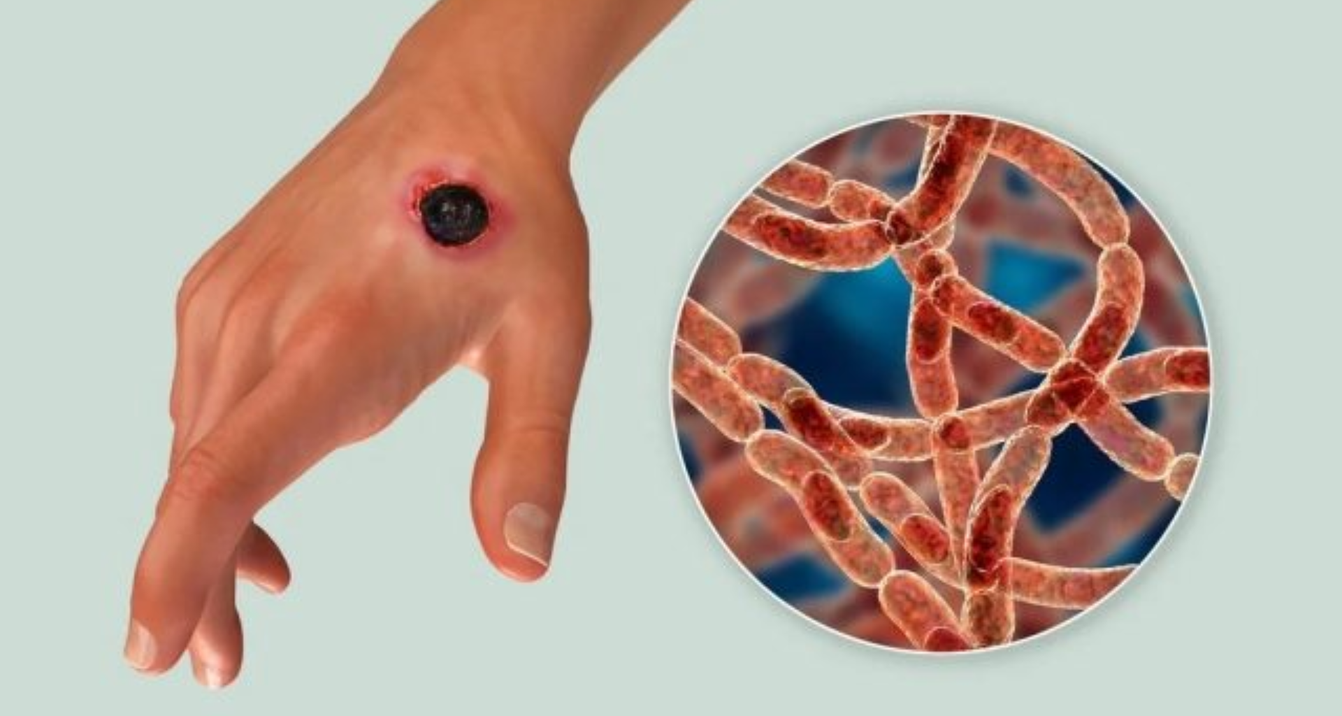 Rivers state govt moves to prevent anthrax disease.